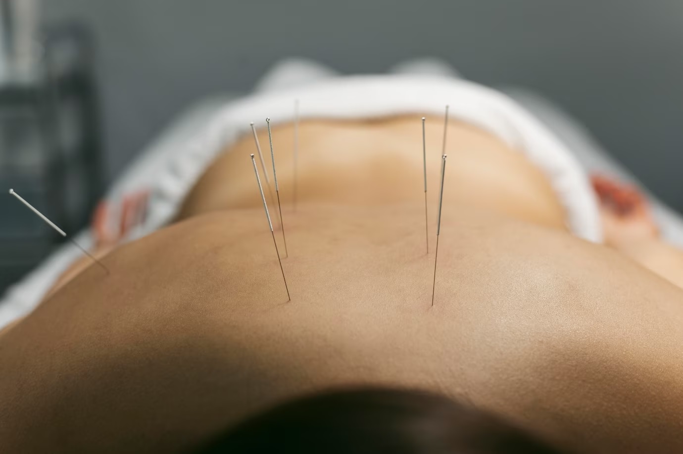 Dry-Needling:-9-Things-You-Need-to-Consider-Before-Trying-It